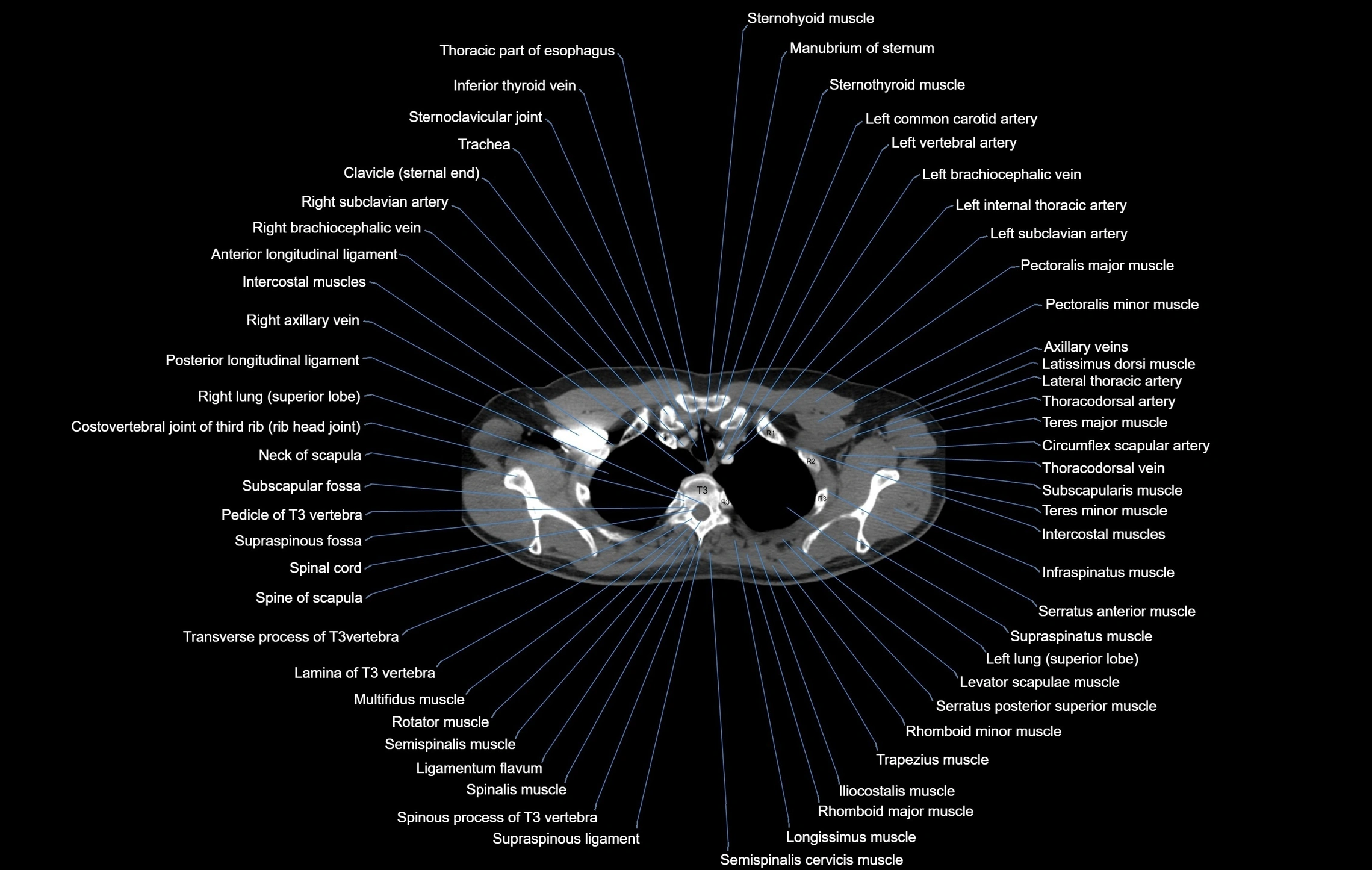 CT chest (thorax) labelled axial cross sectional anatomy radiology image-00018.webp